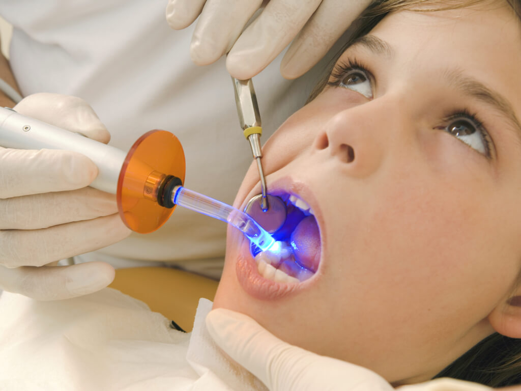 Dental fillings, once placed, are cured by a small handheld UV light. The type of filling will determine how long the material holds.