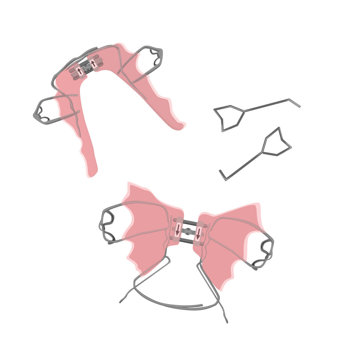 A vector of both a palate expander and a maxillary expander